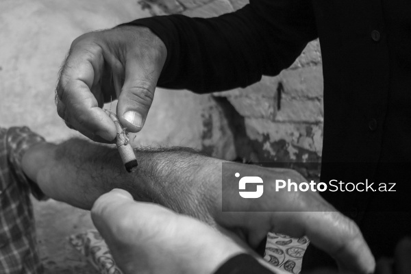 Qədim türkəçarə üsullarından biri olan çıldaq