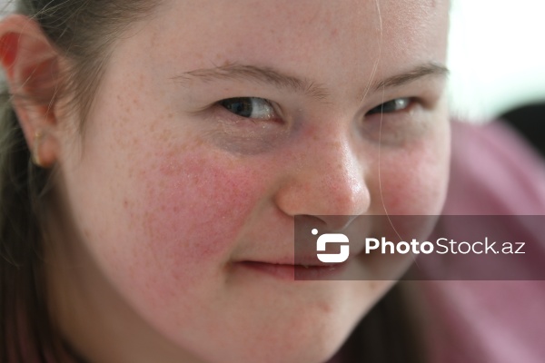 21 mart – Beynəlxalq Daun Sindromu Günü