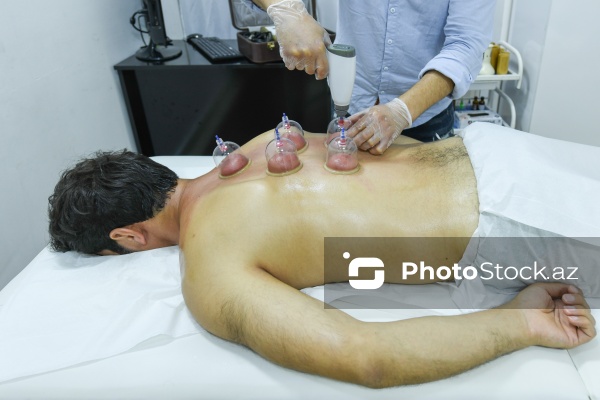 Ənənəvi müalicə üsulu olan hicama prosesi