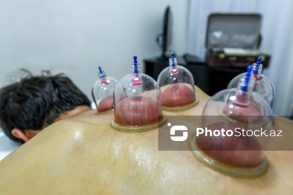 Ənənəvi müalicə üsulu olan hicama prosesi