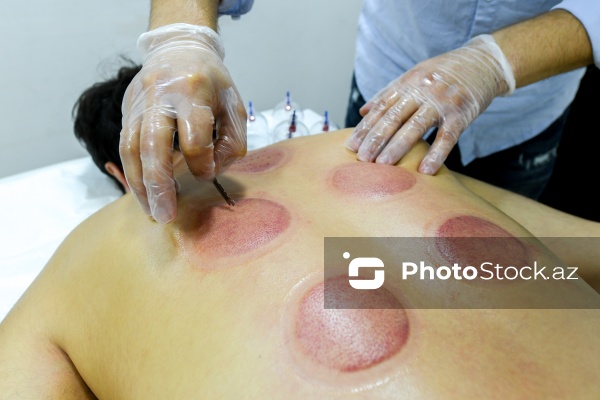 Ənənəvi müalicə üsulu olan hicama prosesi