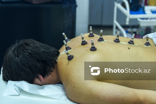 Ənənəvi müalicə üsulu olan hicama prosesi