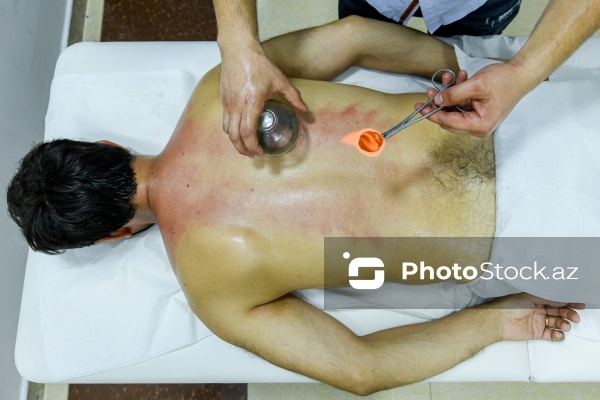 Ənənəvi müalicə üsulu olan hicama prosesi