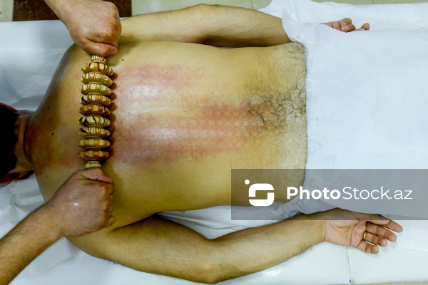 Ənənəvi müalicə üsulu olan hicama prosesi