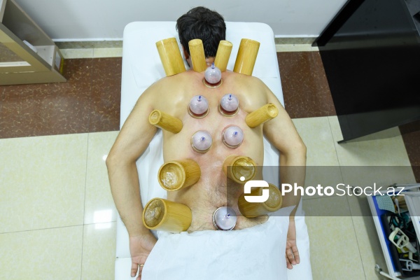 Ənənəvi müalicə üsulu olan hicama prosesi