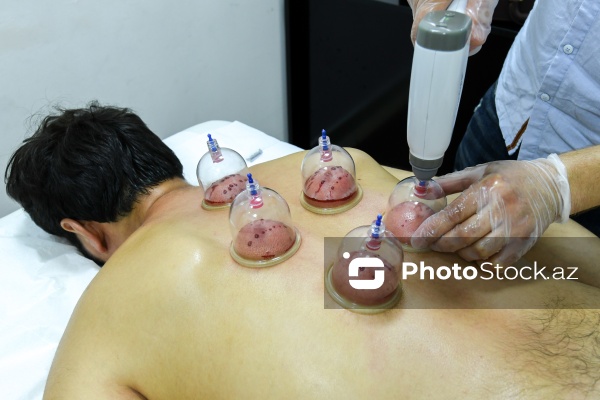 Ənənəvi müalicə üsulu olan hicama prosesi