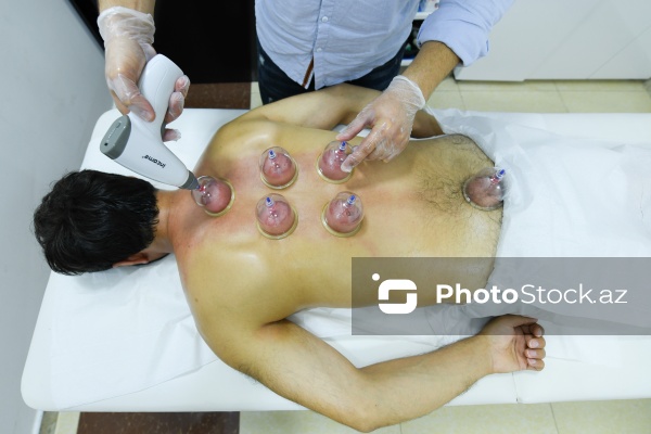 Ənənəvi müalicə üsulu olan hicama prosesi