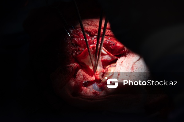 Respublika Neyrocərrahiyyə Xəstəxanasında icra edilən beyin əməliyyatı