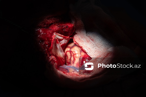 Respublika Neyrocərrahiyyə Xəstəxanasında icra edilən beyin əməliyyatı