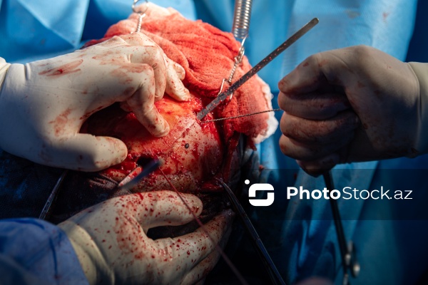 Respublika Neyrocərrahiyyə Xəstəxanasında icra edilən beyin əməliyyatı