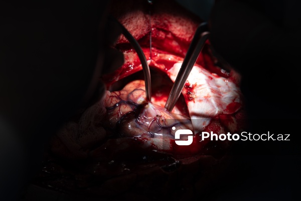 Respublika Neyrocərrahiyyə Xəstəxanasında icra edilən beyin əməliyyatı