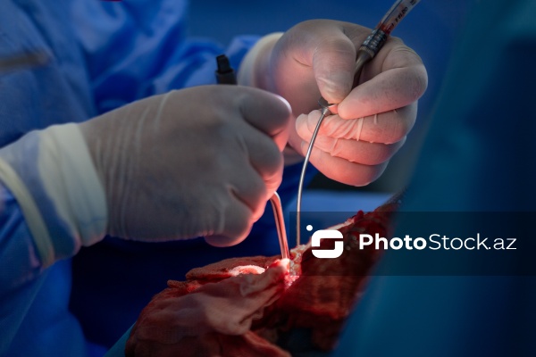 Respublika Neyrocərrahiyyə Xəstəxanasında icra edilən beyin əməliyyatı