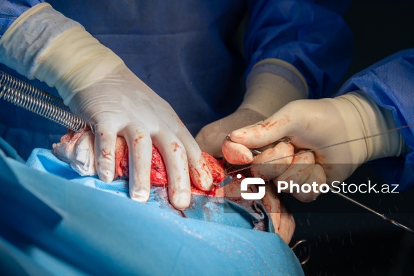 Respublika Neyrocərrahiyyə Xəstəxanasında icra edilən beyin əməliyyatı