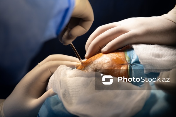 Respublika Neyrocərrahiyyə Xəstəxanasında icra edilən beyin əməliyyatı