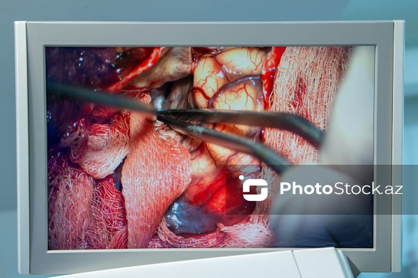 Respublika Neyrocərrahiyyə Xəstəxanasında icra edilən beyin əməliyyatı