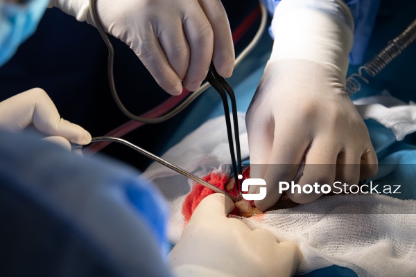 Respublika Neyrocərrahiyyə Xəstəxanasında icra edilən beyin əməliyyatı