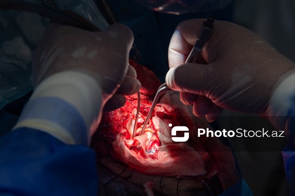 Respublika Neyrocərrahiyyə Xəstəxanasında icra edilən beyin əməliyyatı