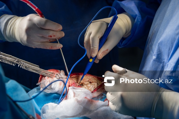 Respublika Neyrocərrahiyyə Xəstəxanasında icra edilən beyin əməliyyatı