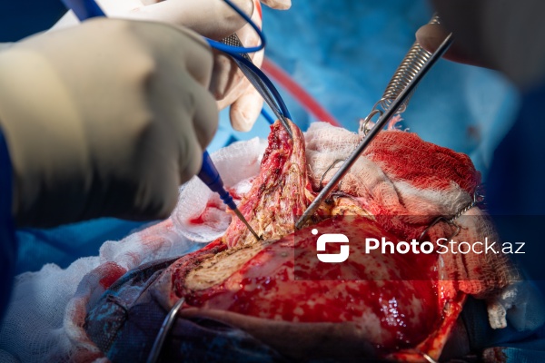 Respublika Neyrocərrahiyyə Xəstəxanasında icra edilən beyin əməliyyatı