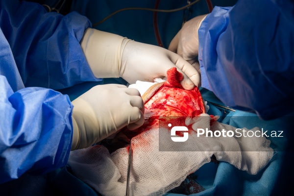 Respublika Neyrocərrahiyyə Xəstəxanasında icra edilən beyin əməliyyatı