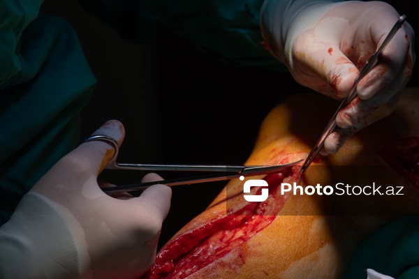 Yeni Klinikada icra edilən ürək əməliyyatı